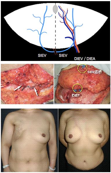 栾杰 乳房再造的微创化、精细化与个性化 1 (1).jpg