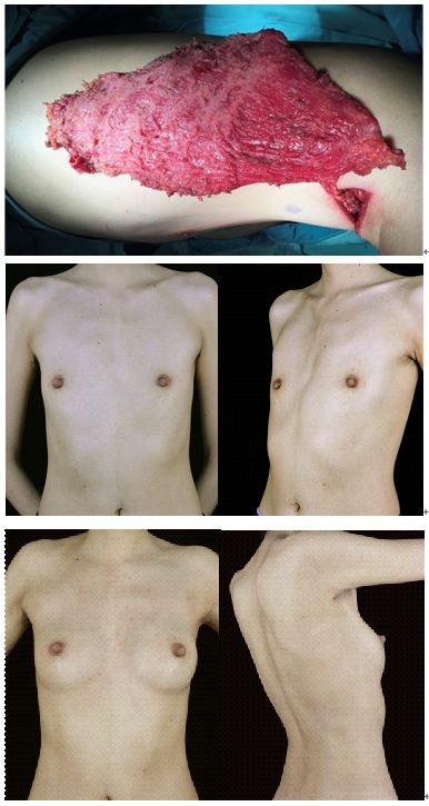 栾杰 乳房再造的微创化、精细化与个性化 2.jpg