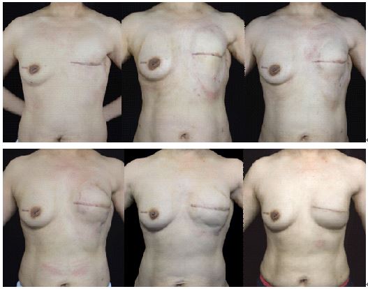 栾杰 乳房再造的微创化、精细化与个性化 3.jpg