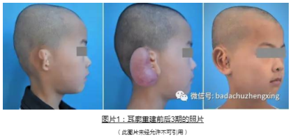 微信 小耳福音：我院开展耳廓整形+听力重建一站式手术治疗1.jpg