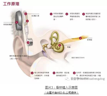 微信 小耳福音：我院开展耳廓整形+听力重建一站式手术治疗3(1).jpg