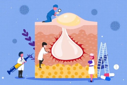 反常性痤疮，是怎么回事？